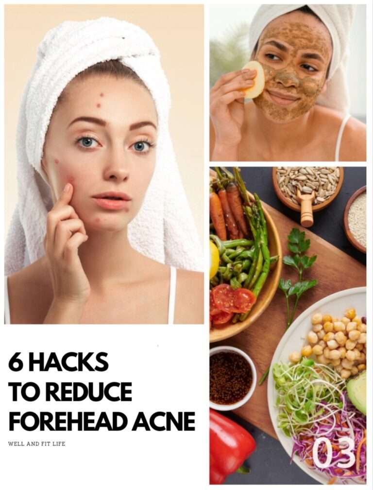 forehead acne